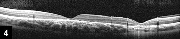 Figure 4: OCT through the fovea and retinotomy site