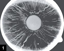 Figure 1: Iris fluorescein angiography in a normal 40-year-old patient