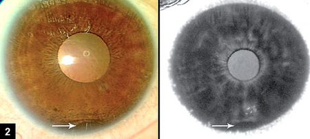 Figure 2: Hypofluorescence (mask effect)