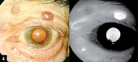 Figure 4: Tumor and feeder vessel hyperfluorescence