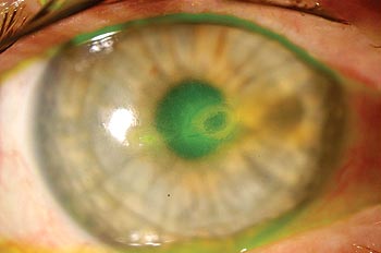 Figure 1: Color photograph of the right eye showing mildly injected conjunctiva 