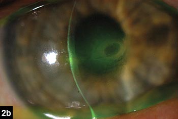 Figure 2b: Slit lamp photograph of the right eye