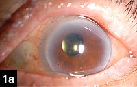 Figure 1a: Color photographs of the injected left eye