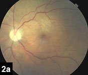 Figure 2a: Notice the clear view of the fundus