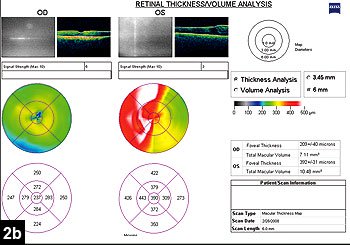 Figure 2b: OCT demonstrating increased macular thickness and intraretinal fluid in the left eye