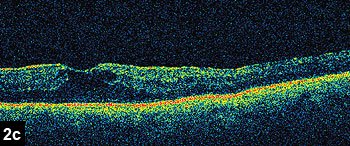 Figure 2c: OCT demonstrating increased macular thickness and intraretinal fluid in the left eye