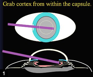 Figure 1: The I&A probe is placed under the edge of the capsulorrhexis, and the cortex is grabbed from within the capsule