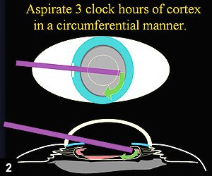 Figure 2: Remove about 3 clock hours of cortex at a time with the circumferential technique