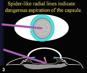 Figure 3: If spider-like wrinkles appear on the posterior capsule, the cause is most likely aspiration of the capsule