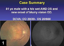 Figure 1: This 81-year-old male has wet AMD in his left eye and BCVA of 20/30 in the right eye