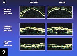 Figure 2: OCT shows patient responded well to bevacizumab in the AMD eye