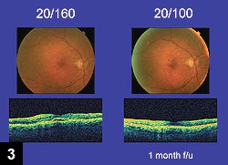 Figure 3: Patient who received ranibizumab injection showed notable improvement at 1 month