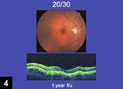 Figure 4: Patient injected with ranibizumab at 1 year follow-up