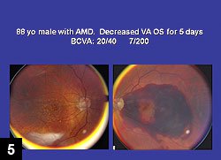 Figure 5: 88-year-old patient with advanced AMD has 7/200 vision in his left eye