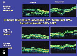 Figure 6: OCT of same patient reveals no systoid macular edema or subretinal blood at days 7 or 14