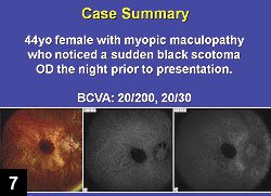 Figure 7: Highly myopic patient presents with extensive hemorrhage