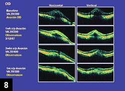 Figure 8: Anatomical changes as seen on OCT up to 1 month follow up after bevacizumab injection