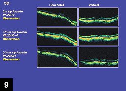 Figure 9: OCT images at 2-, 3.5- and 5.5-month follow-up visits