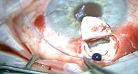 Vision Blue is used during canaloplasty to assess distal outflow system