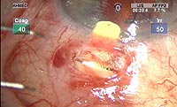 The Solx gold shunt is placed in the suprachoroidal space