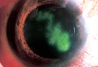 Dendritic corneal ulcer caused by HSV keratitis