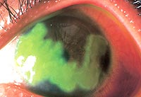 Geographic corneal ulcer caused by HSV keratitis