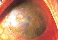 Stromal damage caused by HSV keratitis.