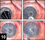 Figure 10: Donor corneal disc (upper row) is then placed on the host corneal bed and firmly attached with the fibrin glue in the interface