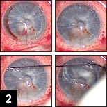 Figure 2: After the creation of the corneal flap that fully encompasses the corneal scar, the interface is rinsed thoroughly with sterile balanced salt solution and the flap is replaced