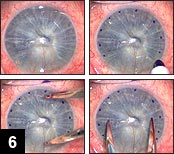 Figure 6: View of the cornea (upper left) 1 month after stage 1 anterior lamellar keratoplasty; (Upper right) A sterile marking pen is used to place multiple dots along the previously created flap edge; (Bottom row)