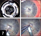 Figure 7: The host cornea (upper left) is trephined using a Hanna trephine. The trephination matches the depth of the flap that was previously created; (Upper right) View of the completed trephination; (Bottom row)