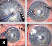 Figure 8: Progressive peeling of the host corneal disc of tissue. Any strands of circumferential attachment are severed using Vannas scissors