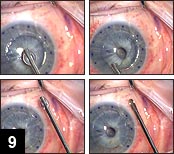 Figure 9: Component 1 (upper row) of the fibrin glue is applied to the host corneal bed;