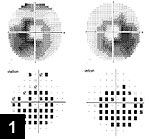 Humphery visual fields showing bilateral doughnut scotomata