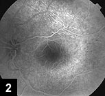 Fluorescein angiography of the left eye at 48 seconds showing chorioretinal folds superotemporally