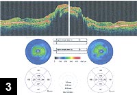 Optical coherence tomography showing retinal thinning and retinal cysts