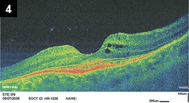 UHR-OCT of the left eye showing retinal cysts and loss of the inner segment-outer segment junction outside of the fovea