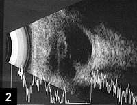 Figure 2: B-scan ultrasound