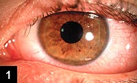 A 19-year-old patient presented with itching, tearing, burning and redness