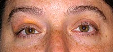 External photograph showing yellow right upper lid discoloration and mild mechanical ptosis