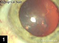 Figure 1: Slit-lamp view of the preoperative appearance of the cornea