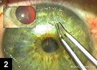 Figure 2: The corneal scar being mechanically peeled from the corneal surface