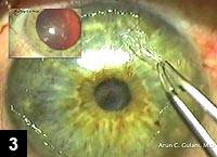 Figure 3: Mechanical removal of the corneal scar under the excimer laser