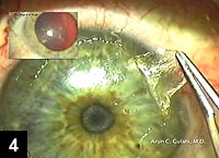 Figure 4: View of the corneal scar being removed mechanically from the corneal surface