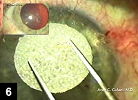 Figure 6: Application of mitomycin-C 0.02% to the central cornea