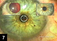 Figure 7: Immediate postoperative view of the cornea