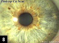 Figure 8: Postoperative view of cornea after mechanical removal of the corneal scar