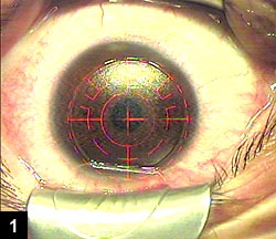 Figure 1: After cataract surgery, the femtosecond flap is lifted and the residual refractive error is treated.