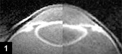 Figure 1: Crystalline growth with age shown in vivo composite picture of a 49-year-old patient on the left and a 24-year-old patient on the right