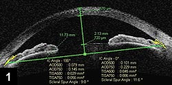 Figure 1: Preoperative evaluation of the anterior segment of a patient with 2 D of hyperopia in consideration of LASIK